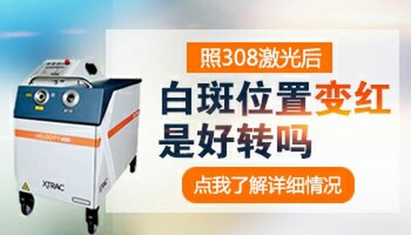 白癜风能治好吗